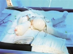 陵水一作坊起火3人烧伤 9月大婴儿植皮手术后未“脱险” - 海南新闻中心