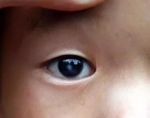 8岁女孩双眼先天白 在“话麻”下顺利完成手术！ - 海南新闻中心