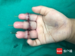 昌江1岁多女童被奶茶封口机切断3根手指 医院历时10小时断指再植成功 - 海南新闻中心