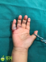事发昌江！发动机皮带“咬”断2岁幼童右手小指，医生这样说…… - 海南新闻中心
