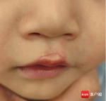 儋州一幼童在幼儿园被咬伤嘴唇缝6针 园方：确实存在监管失职 - 海南新闻中心