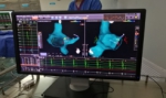 琼南地区首例零射线射频消融术在三亚市人民医院心内科导管室完成 - 海南新闻中心